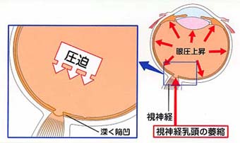 眼圧上昇による視神経萎縮.jpg