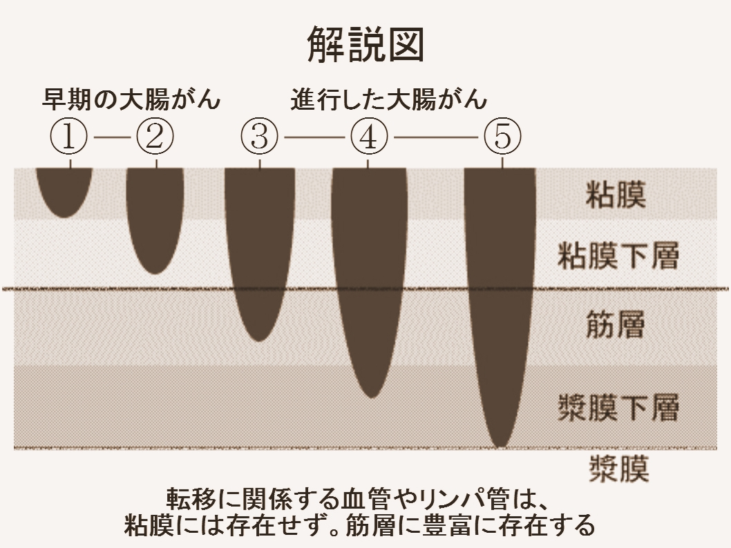 大腸癌